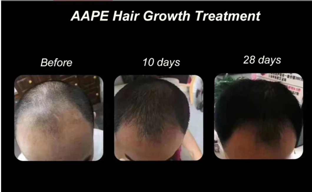 Efficient Aape Anti Women′ and Men′ Hair Loss Hair Loss Care Repairing Hair Growth Hair Regrowth Stem Cell Treatment Hair-Loss Prevention Skin Anti-Wrinkle